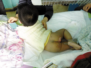 遇上孩子烧烫伤教你这样做图片1