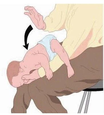 宝宝窒息的急救主要方法图片1
